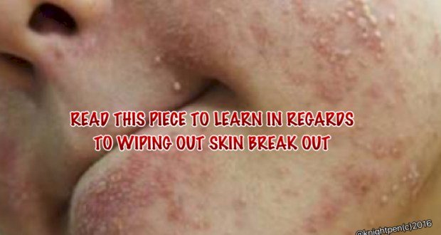 READ THIS PIECE TO LEARN IN REGARDS TO WIPING OUT SKIN BREAK OUT