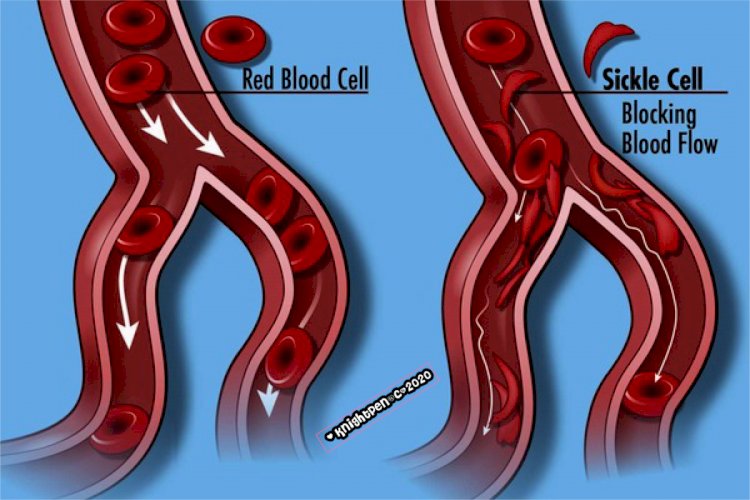 IMPRESSIVE TURN AROUND IN GENETIC DIAGNOSIS & TREATMENT OF SICKLE CELL DISEASE